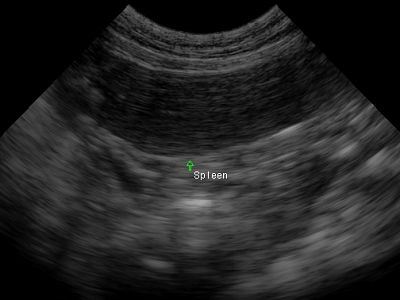 spleen